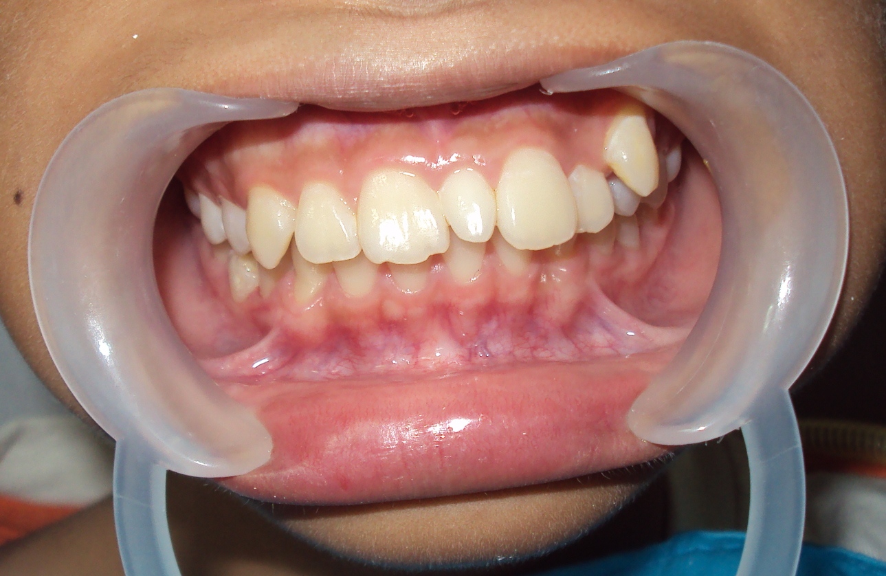 Поліодонтія (гипердонтія): аномалія надкомплектних зубів » журнал здоров'я iHealth 1