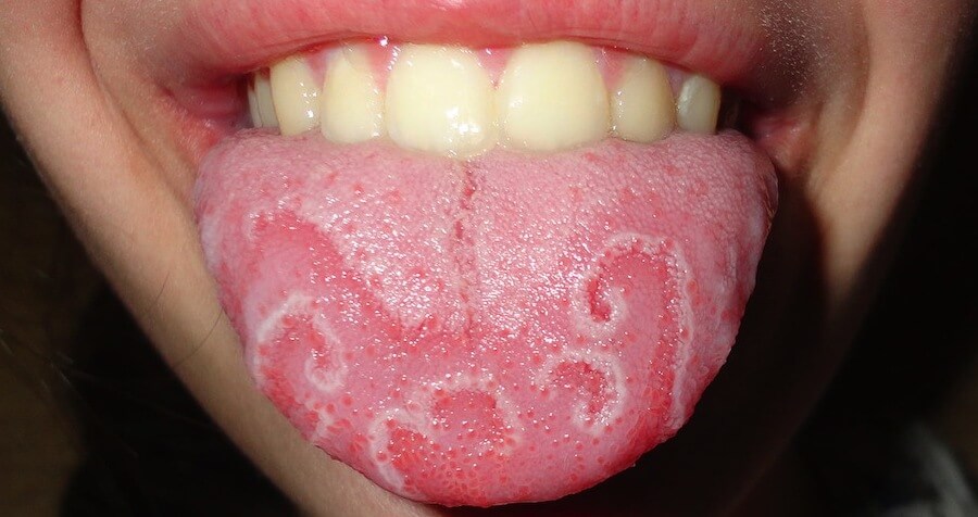 Георгафический язик: причини виникнення, лікування » журнал здоров'я iHealth 