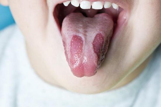 Георгафический язик: причини виникнення, лікування » журнал здоров'я iHealth 1
