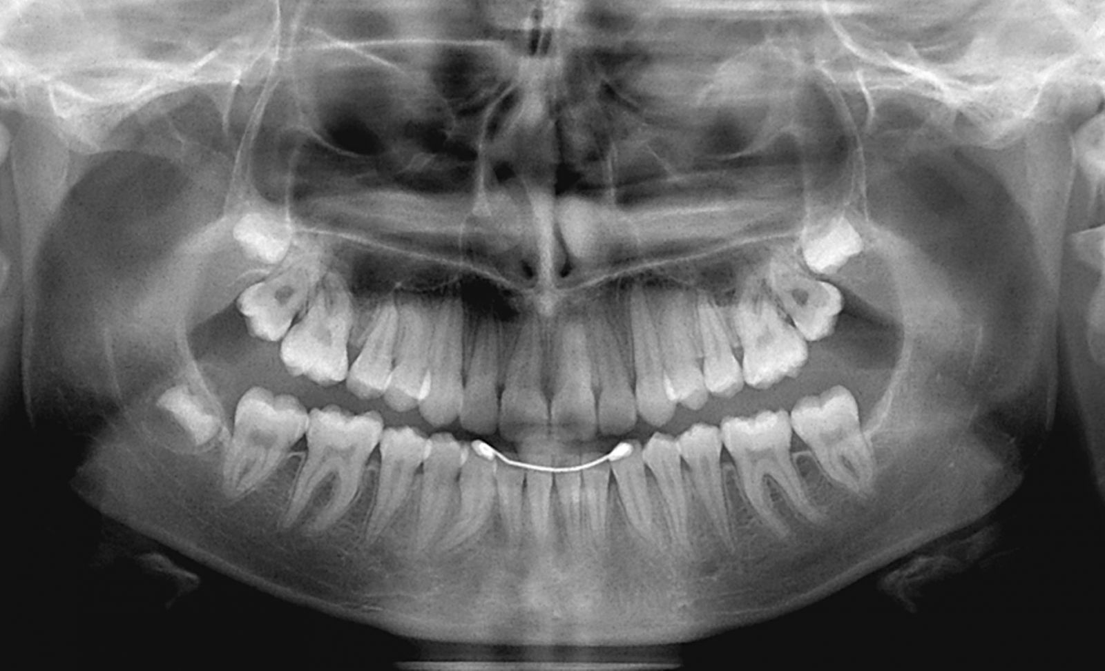 Панорамний знімок зубів: як роблять і для чого? » журнал здоров'я iHealth 1