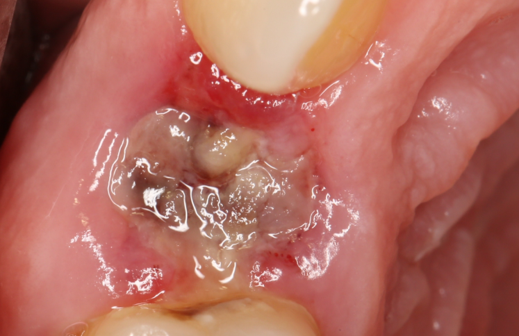 Альвеоліт після видалення зуба: симптоми, лікування » журнал здоров'я iHealth 
