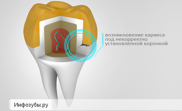 Болит зуб под коронкой: как снять боль в домашних условиях?