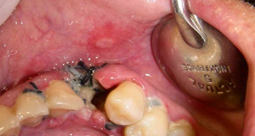 Альвеоліт після видалення зуба: симптоми, лікування » журнал здоров'я iHealth 1