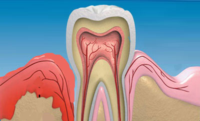 Як зміцнити ясна якщо хитаються зуби в домашніх умовах? » журнал здоров'я iHealth 