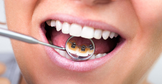 Скільки коштує поставити брекети на зуби дитині і дорослому? » журнал здоров'я iHealth 