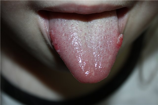 Дитина прикусив язик до крові: що робити? » журнал здоров'я iHealth 