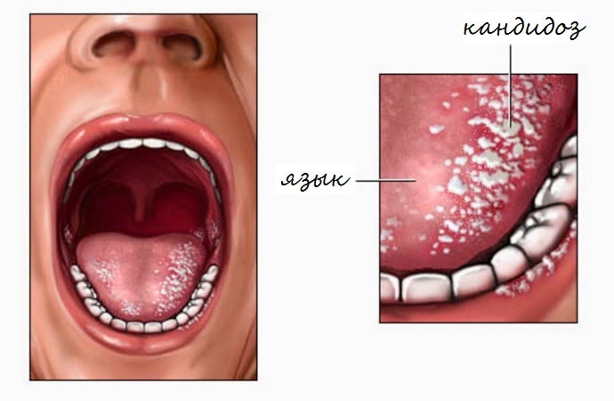 Кандидоз порожнини рота у дорослих і дітей: лікування, фото » журнал здоров'я iHealth 2