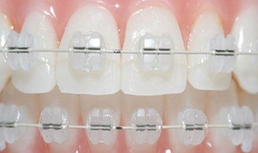 Сапфірові брекети на зуби: фото до і після, ціна, відгуки » журнал здоров'я iHealth 1