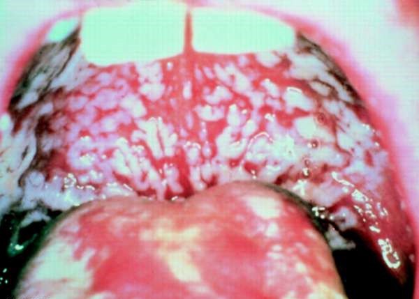 Кандидоз порожнини рота у дорослих і дітей: лікування, фото » журнал здоров'я iHealth 
