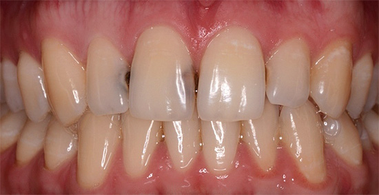 Карієс на передніх зубах: лікування, фото до і після » журнал здоров'я iHealth 1
