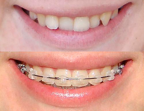 Сапфірові брекети на зуби: фото до і після, ціна, відгуки » журнал здоров'я iHealth 