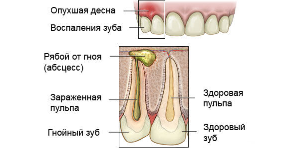 Запалення кореня зуба: фото, симптоми, лікування » журнал здоров'я iHealth 