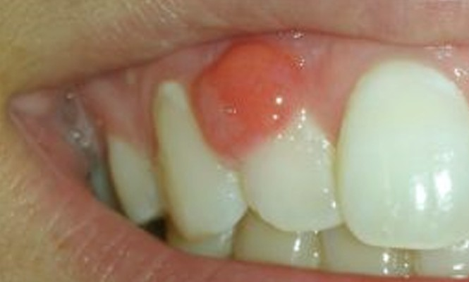 Запалення кореня зуба: фото, симптоми, лікування » журнал здоров'я iHealth 1