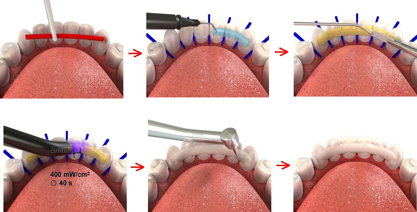 Шинирование зубов: что это, фото до и после, отзывы