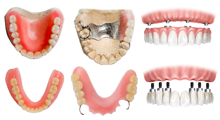 Види зубних протезів: які краще, ціна, відгуки » журнал здоров'я iHealth 1