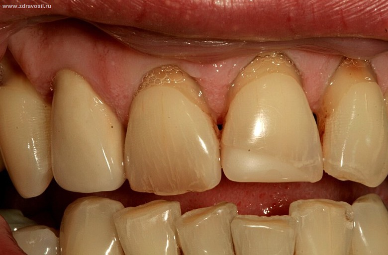 Поддесневой зубний камінь: симптоми, фото, видалення » журнал здоров'я iHealth 1