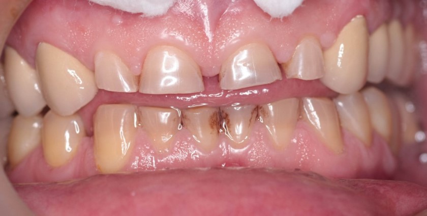 Патологічна стертість зубів: симптоми, лікування » журнал здоров'я iHealth 