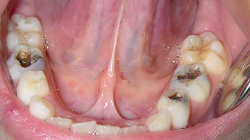 Пульпіт молочних зубів у дітей: симптоми, лікування, фото » журнал здоров'я iHealth 