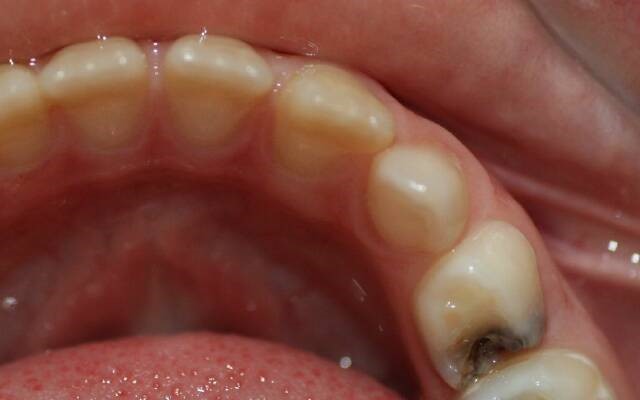 Пульпіт молочних зубів у дітей: симптоми, лікування, фото » журнал здоров'я iHealth 1