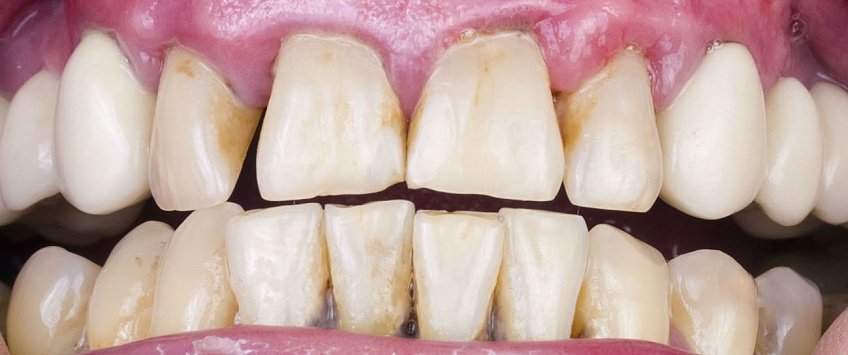 Ерозія зубної емалі: фото, причини й лікування, наслідки » журнал здоров'я iHealth 1