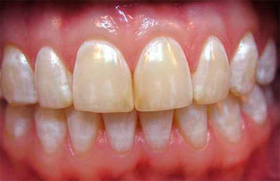 Оскома на зубах і язиці: причини, як позбутися » журнал здоров'я iHealth 