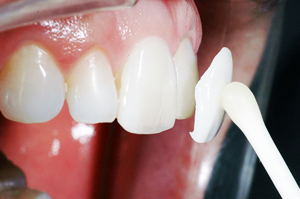 Люмініри на зуби: що це, фото, відгуки, плюси та мінуси, ціна » журнал здоров'я iHealth 1