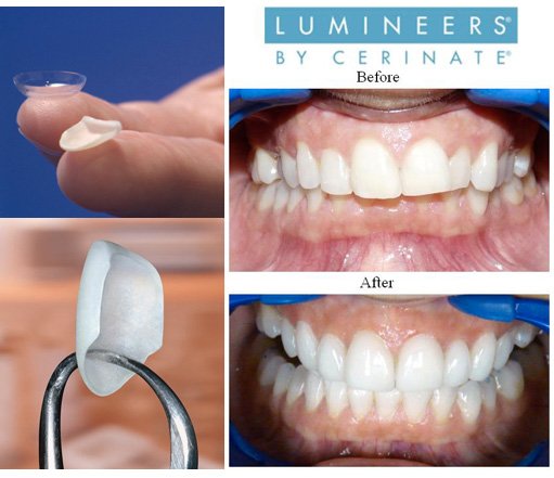 Люмініри на зуби: що це, фото, відгуки, плюси та мінуси, ціна » журнал здоров'я iHealth 
