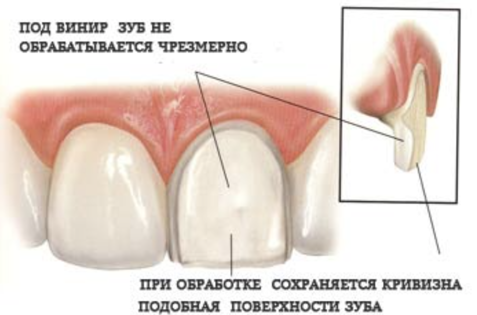 Препарування (обточування) зубів: під металокерамічну коронку, вініри » журнал здоров'я iHealth 2