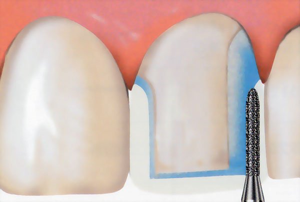 Препарування (обточування) зубів: під металокерамічну коронку, вініри » журнал здоров'я iHealth 