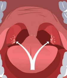 Гнойные и казеозные пробки в горле: причины, лечение
