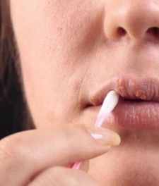 Как лечить хейлит на губах?