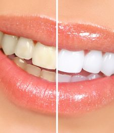 Как отбелить зубы в домашних условиях без вреда эмали?