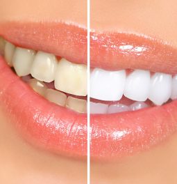 Как отбелить зубы в домашних условиях без вреда эмали?