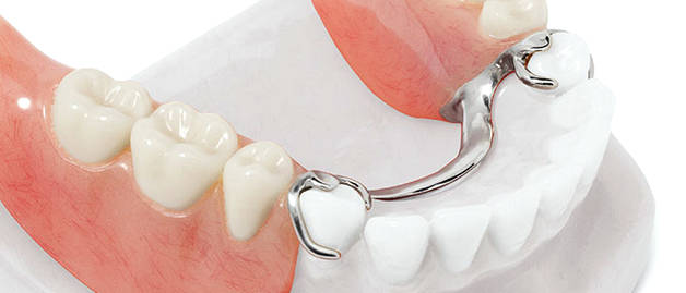 Как выглядят ацеталовые зубные протезы?