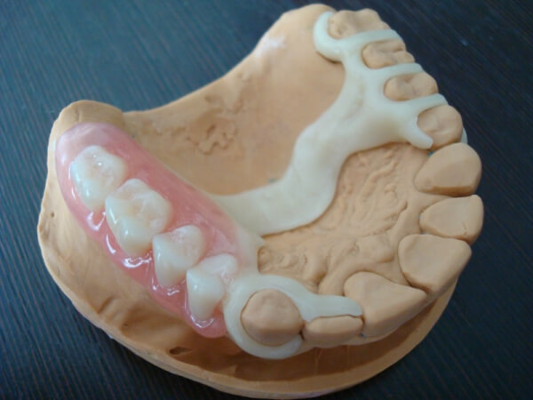 Фото ацеталовых зубных протезов