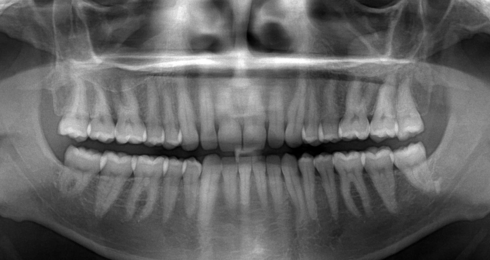 Панорамный снимок зубов - фото