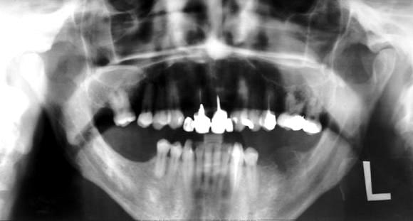 Остеомиелит челюсти: рентгеновский снимок