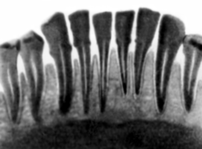 Рентгеновский снимок пародонтоза