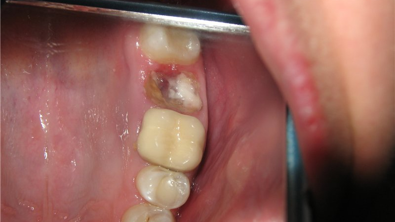 После удаления зуба в лунке что-то белое