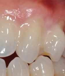 Фторирование зубов: как делается процедура?