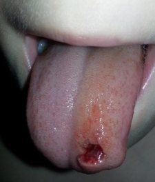Ребенок прикусил язык до крови: фото