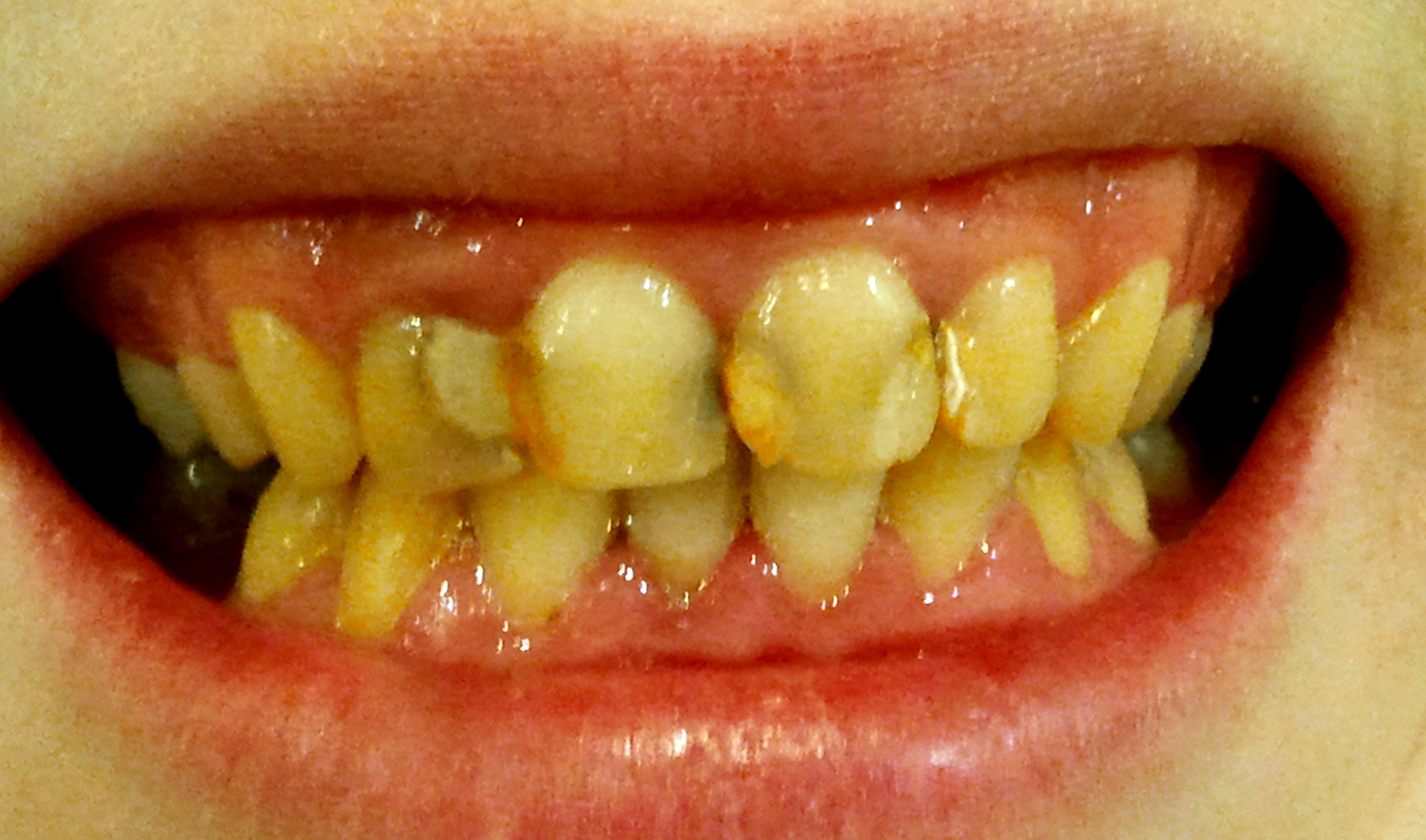 Дисколориты зубов