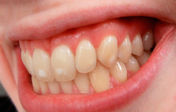 Гиперплазия зубов - фото