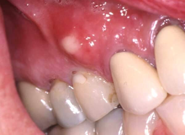 Как выглядит зубной абсцесс?