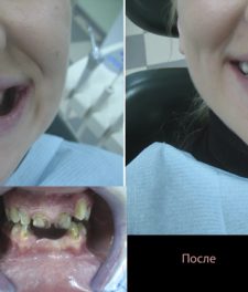 Кривые зубы: фото до и после лечения