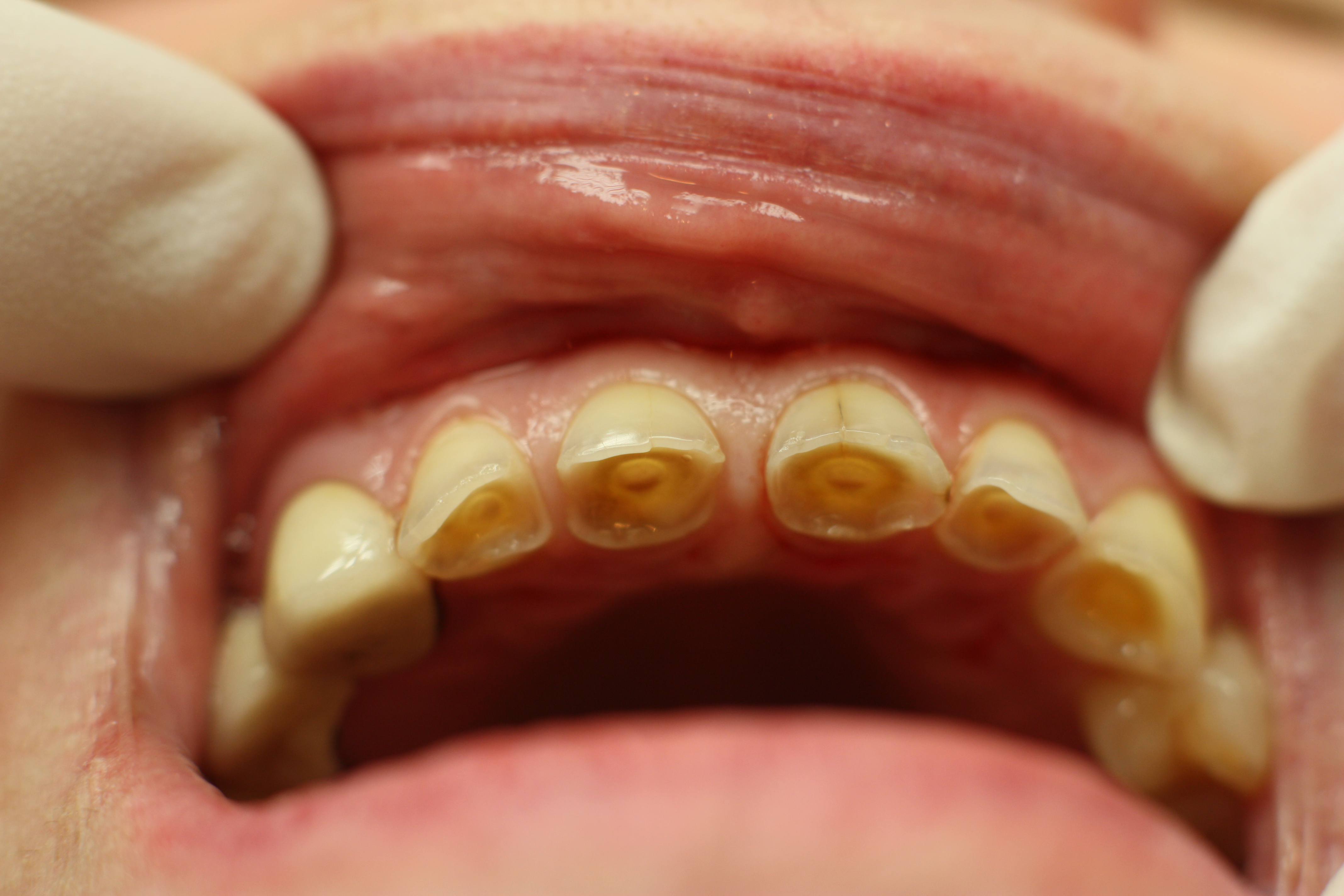 Патологические нарушения зубов