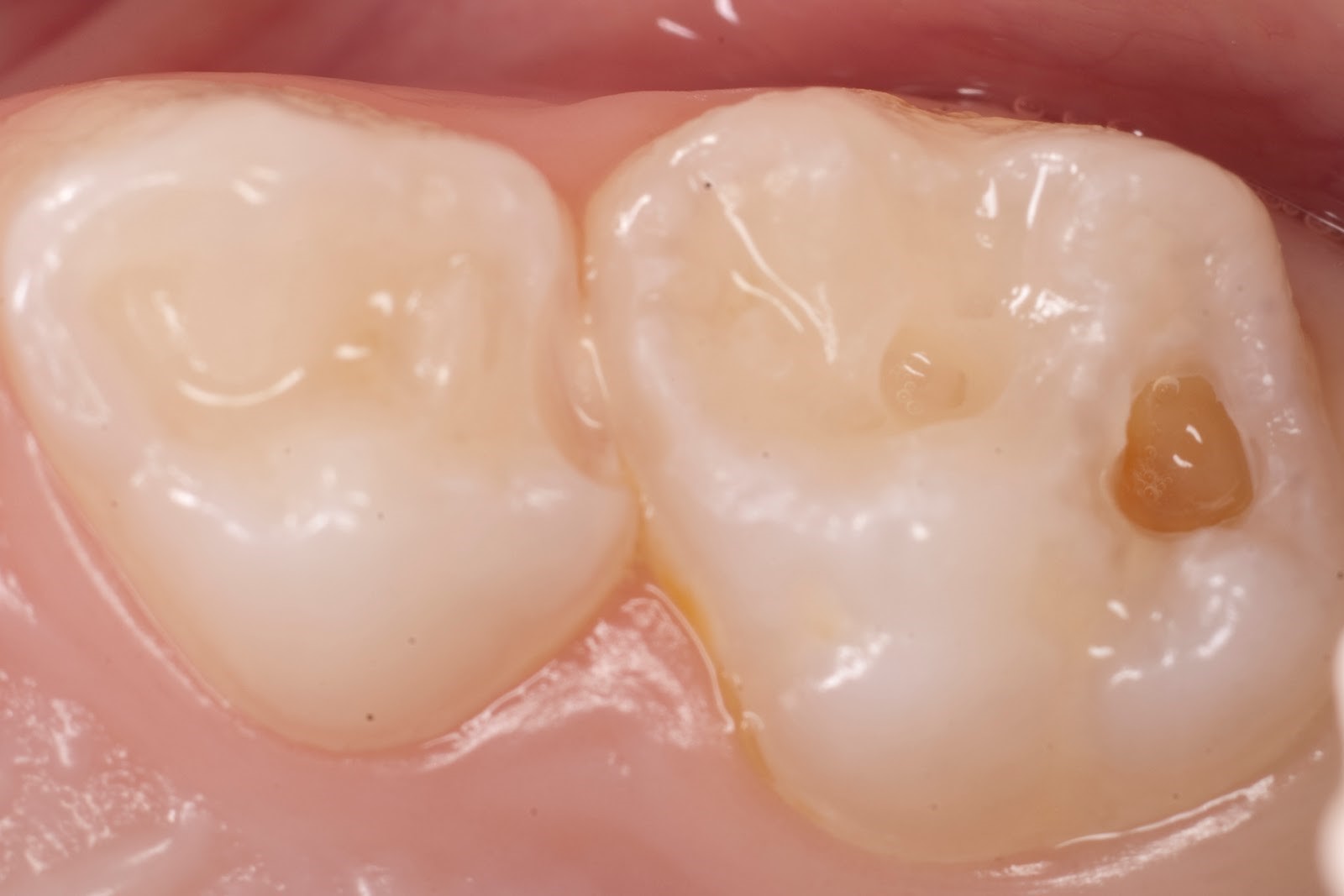 Средний кариес молочных зубов - фото
