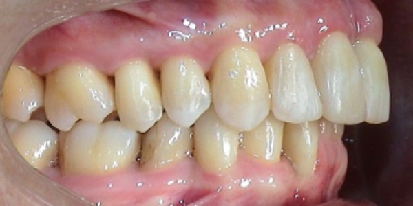 Зубной налет - фото