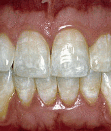 Фото белых пятен на зубах и их лечение