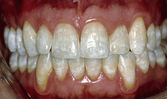 Фото белых пятен на зубах и их лечение